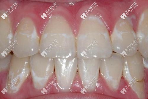 孩子做正畸后牙齒脫礦還有救嗎？白斑到底能不能消除？