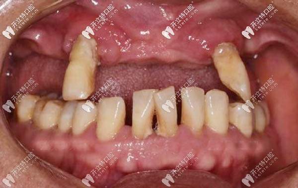 上頜長(zhǎng)期缺牙導(dǎo)致牙齒脫落