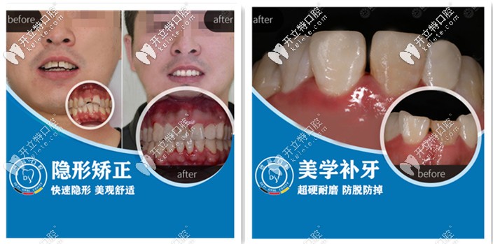 德益口腔-牙齒矯正和補牙案例展示