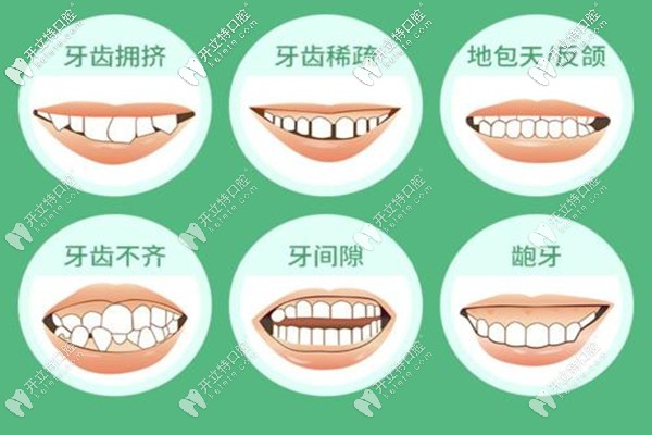 蘭州牙王國口腔金屬矯正，舌側(cè)矯正多少錢