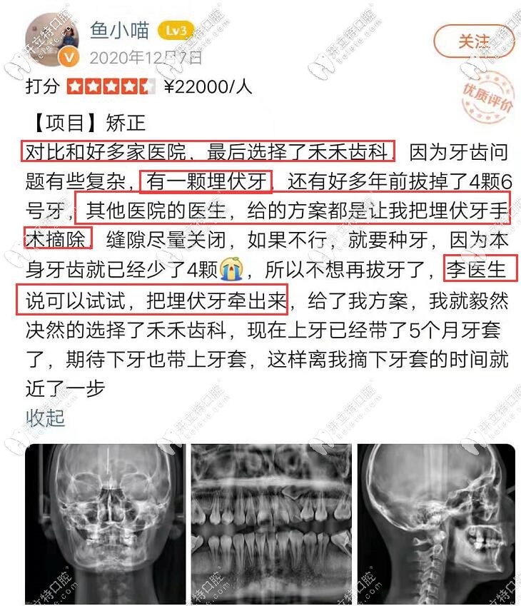 埋伏牙顧客在禾禾齒科的正畸體驗(yàn)