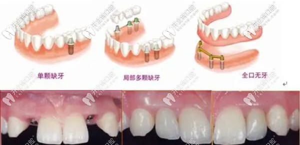 重慶牙博士當天種牙、當天戴牙當天用