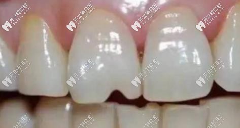 常吃堅果會加速牙齒的磨耗，使牙齒出現(xiàn)裂紋