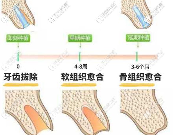 即拔即種種植技術