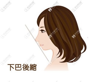 齙牙下巴后縮