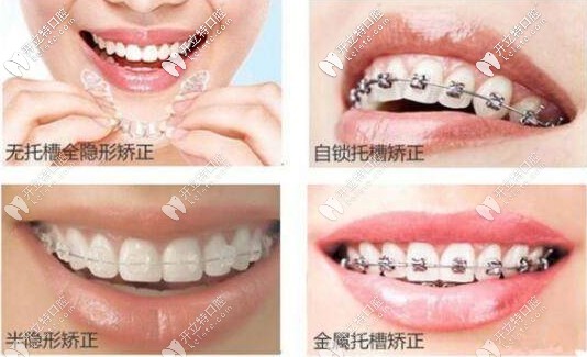 牙齒矯正方式