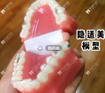 隱適美模型