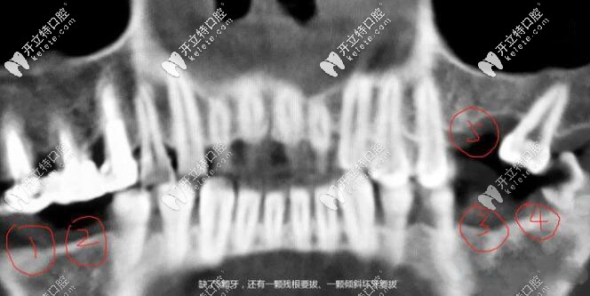 兩邊后牙連缺兩顆已有五六年,用瑞士ITI種植體半小時(shí)就解決
