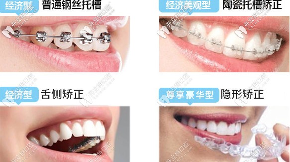 牙齒矯正器的種類及價(jià)格