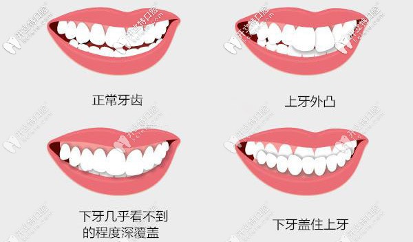 牙齒外凸、深覆合等情況都需要矯正