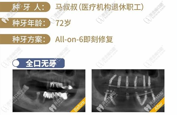 南寧柏樂口腔醫(yī)院種植牙技術(shù)咋樣?醫(yī)生列表的彭布強可靠嗎