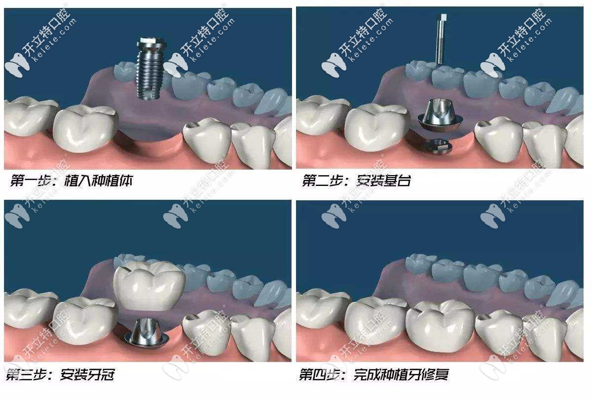 淚目！這份寶雞各口腔醫(yī)院價(jià)目表中，種牙、正畸收費(fèi)不貴
