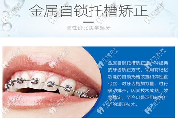 西安團圓口腔自鎖托槽整牙技術