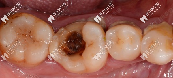 牙齒大面積缺損，用康泰健格萊美瓷嵌體修復(fù)案例分享