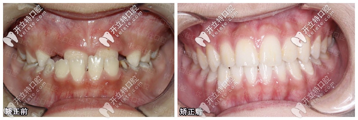 在優(yōu)麗仕口腔矯正前后對(duì)比圖
