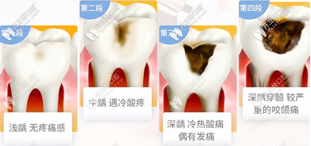 形成蛀牙的過(guò)程