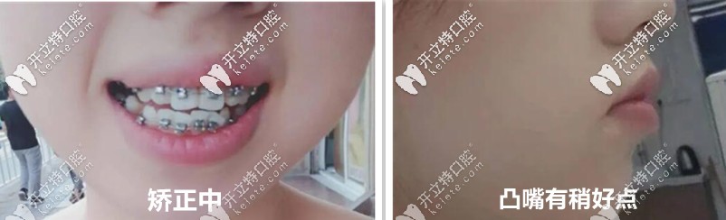 后來慢慢的開始有變化了，牙齒感覺在內(nèi)收了
