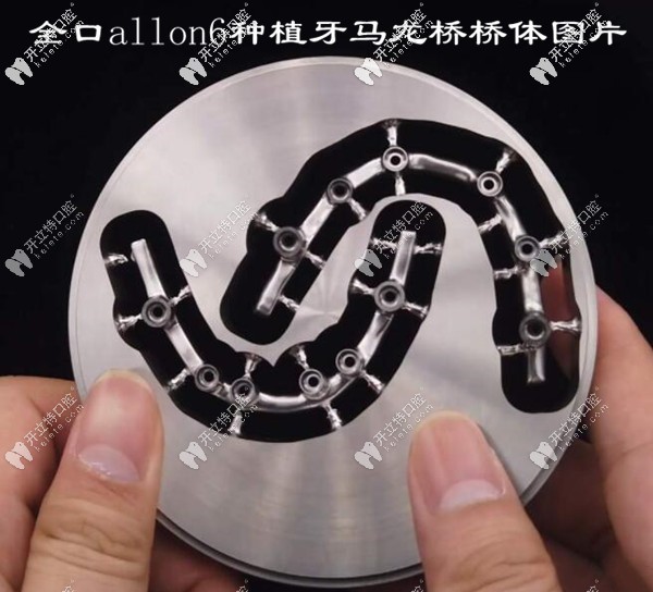 深圳馬瀧齒科做allon4馬龍橋種植牙怎么樣?優(yōu)缺點都在這嘍