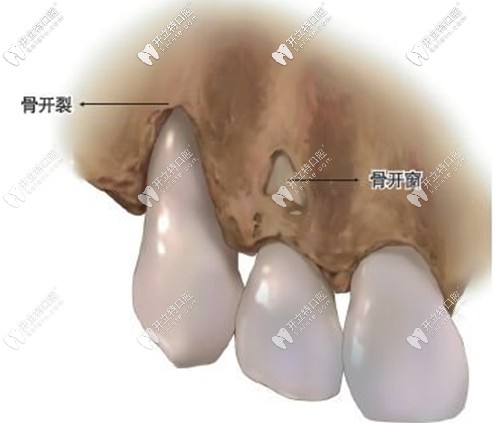 正畸中骨開窗或骨開裂示意圖