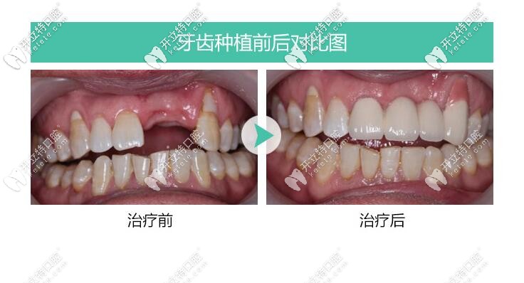 前牙美學(xué)種植修復(fù)案例