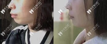 深覆合、齙牙顧客—拔牙7顆做的美國進(jìn)口自鎖金屬托槽