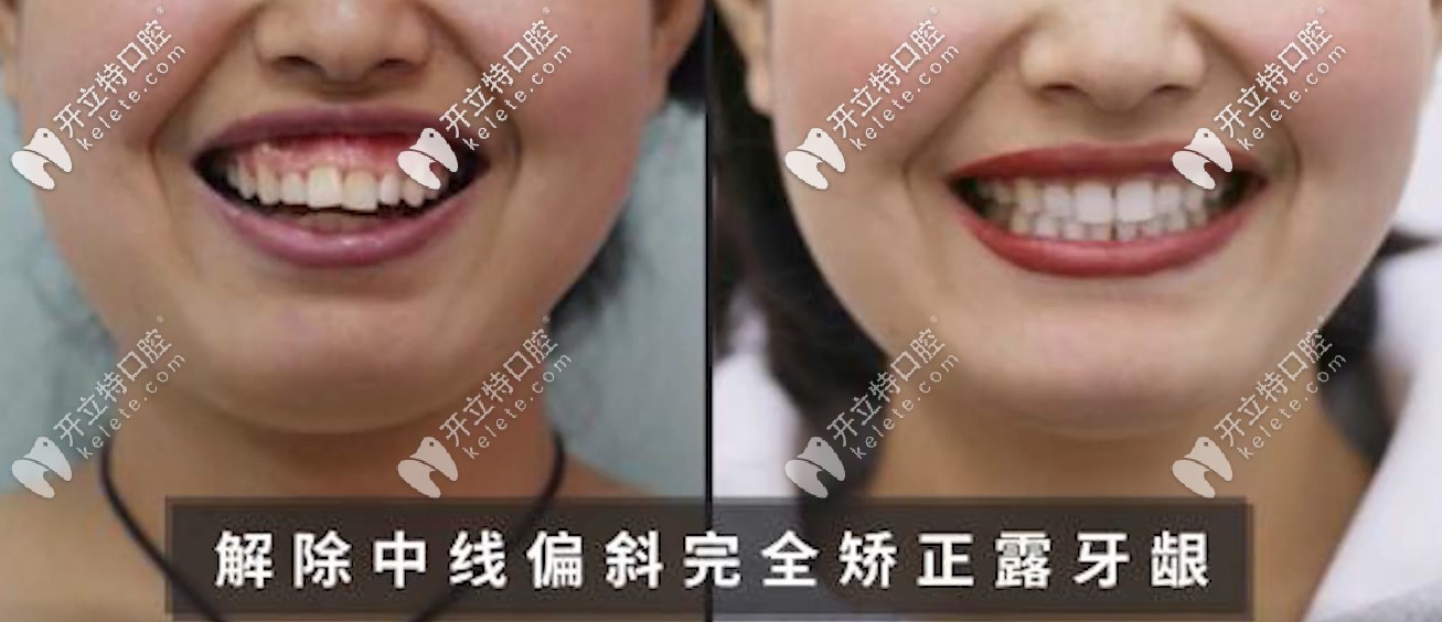 解決了露齦笑額齙牙的問題，小姐姐笑的不要太開心