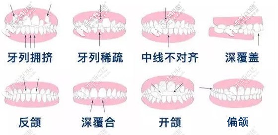  渭南牙科做牙齒矯正多少錢？想知道隱形和金屬矯正的價(jià)格