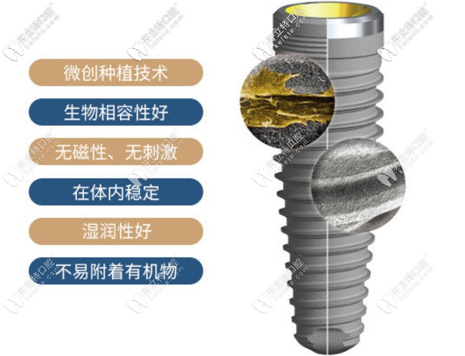 瑞典諾貝爾種植牙一顆多少錢