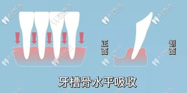 牙槽骨會慢慢吸收示意圖