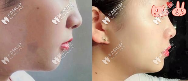 1年后側(cè)面對比圖，效果顯著