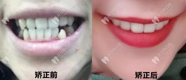 通過3年矯正變化，現(xiàn)在我的牙齒美美噠