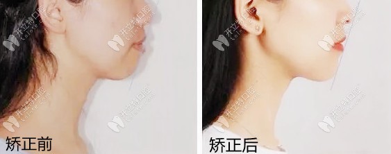 露齦笑戴陶瓷半隱形矯正有效果嗎？親身整牙經(jīng)歷來(lái)解答~