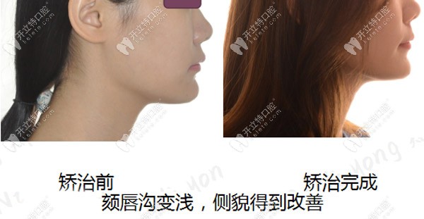 深覆合矯正后頦唇溝變淺，側(cè)臉有了明顯的改善