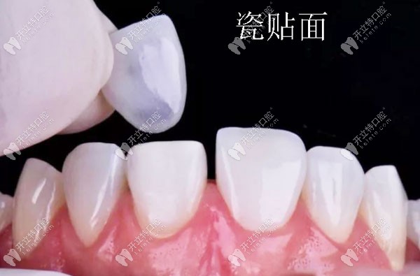 瓷貼面修復過程圖