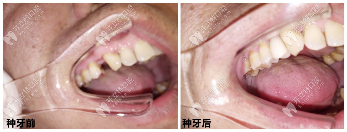 石家莊中諾口腔種牙好嗎？從種牙案例、醫(yī)生技術(shù)來看！