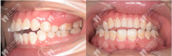 開頜在西安鼎秀齒科做的金屬自鎖牙齒矯正來評價(jià)下怎么樣