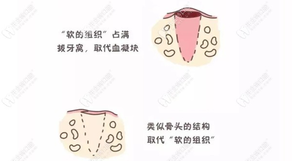 拔牙后的恢復(fù)過程