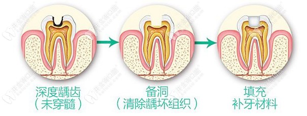 補(bǔ)牙簡單流程