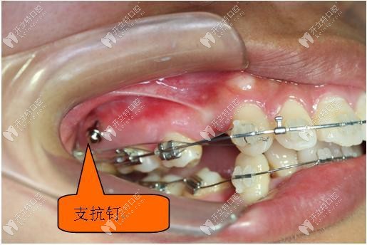 種植支抗釘?shù)耐庥^