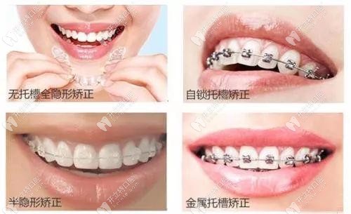 這是四種牙套的外觀對比