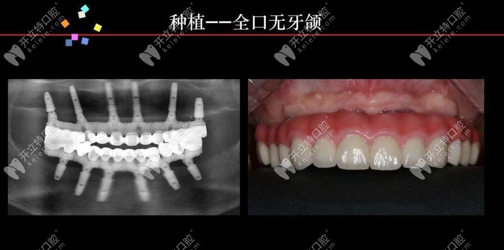 馬龍橋全口種植修復(fù)