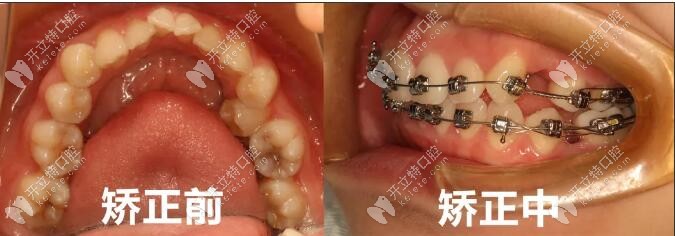 陳庫(kù)正畸醫(yī)生牙齒矯正案例一