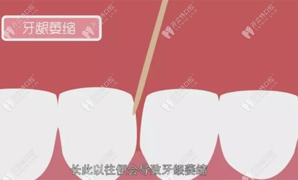 牙簽會導致牙齦萎縮