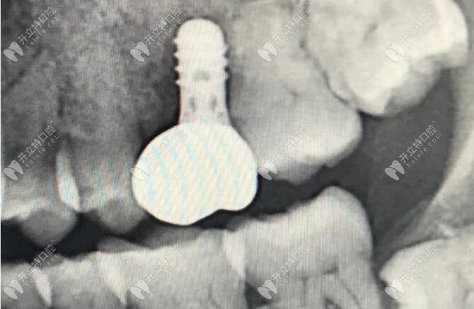 吸煙是種植牙的死敵?這個(gè)抽煙得種植體周圍炎的案例來解答