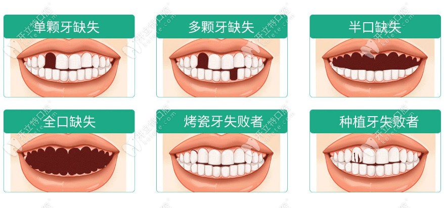 珠海九龍口腔韓國進口種植牙適應癥