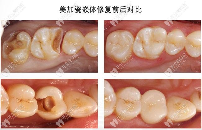 瓷嵌體對(duì)比修復(fù)