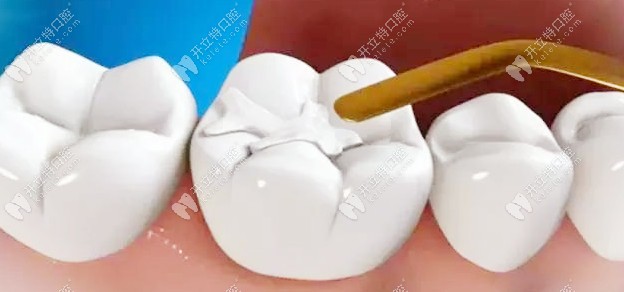又問美國進(jìn)口3M樹脂補(bǔ)牙的價(jià)格？z350與250多少錢都在這了！