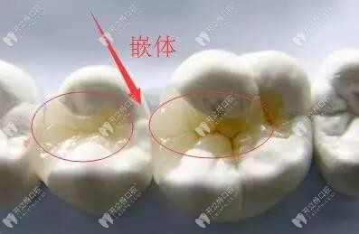 嵌體修復(fù)牙齒的癥狀