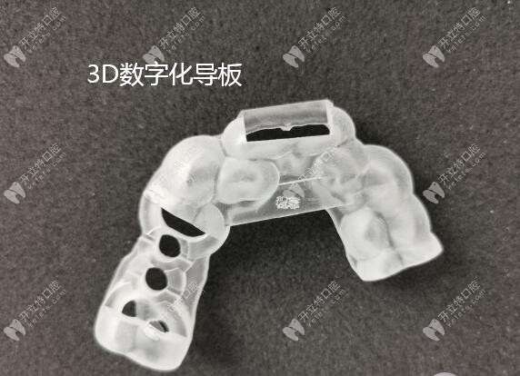 3D數(shù)字化導(dǎo)板種植牙技術(shù)