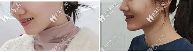 二次矯正：我決定在德益口腔做國產(chǎn)金屬托槽正畸經(jīng)歷！